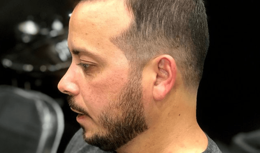 FACIAL SHAVES